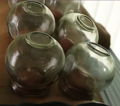 cupping-therapy-image