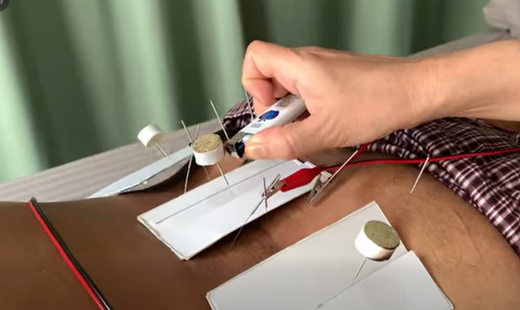 electro-accupunture-image