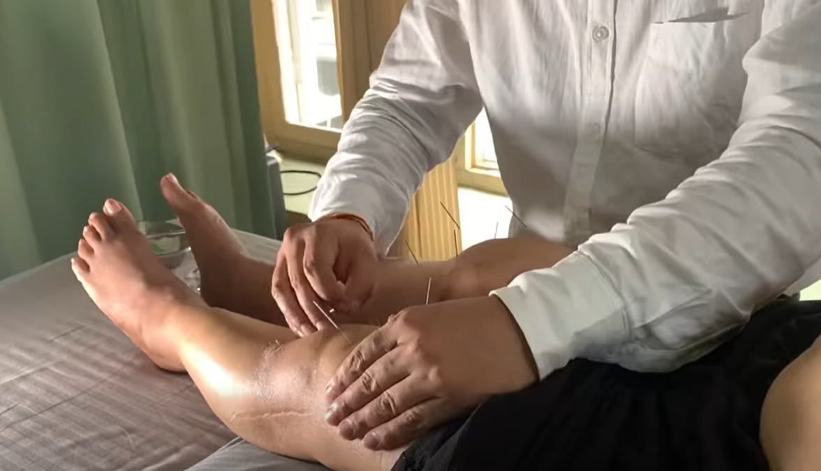 acupuncture-image